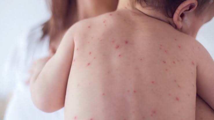US measles cases